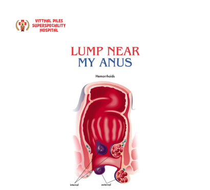 Lump Near My Anus